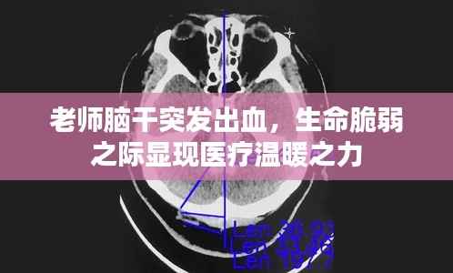 老师脑干突发出血,生命脆弱之际显现医疗温暖之力