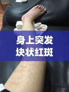 身上突发块状红斑,身上突然出现大块红斑,很痒是怎么回事,是过敏么